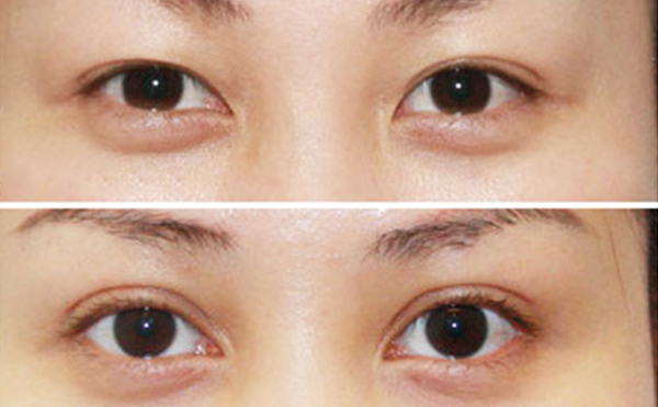 內(nèi)雙做雙眼皮是什么價(jià)格？效果怎么樣？