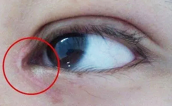 內(nèi)眼角修復(fù)難不難？哪些情況需要修復(fù)?