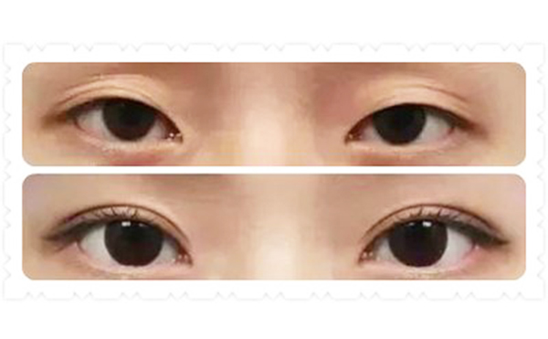 韓式三點雙眼皮價格是多少?術后為什么變成多眼皮?
