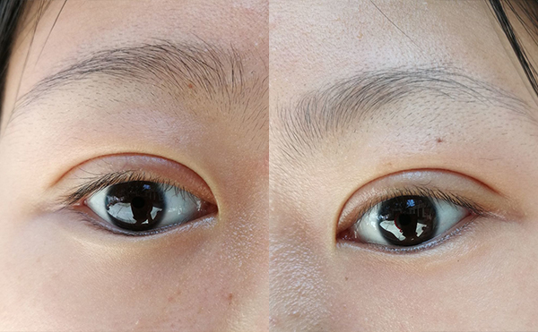 雙眼皮術后有肉條怎么辦?什么時候修復效果好?