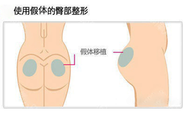 假體豐臀多少錢？假體豐臀效果是永久的嗎？
