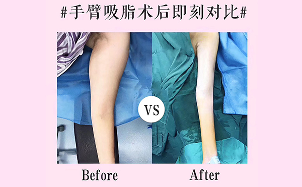 手臂吸脂會反彈嗎？