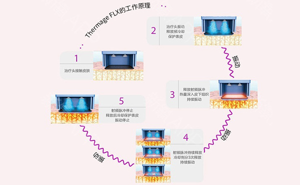 電波拉皮怎么去除魚(yú)尾紋？