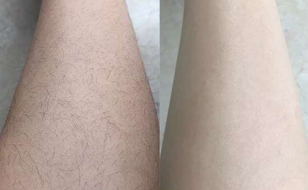 冰點(diǎn)脫腿毛效果怎么樣？