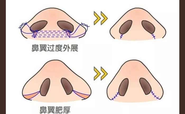 鼻頭肥大怎么改善？鼻頭肥大矯正術(shù)多少錢？