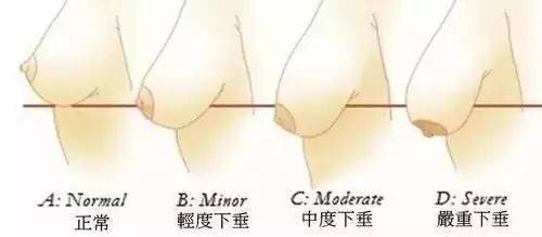 產(chǎn)后胸部下垂怎么辦？