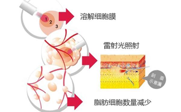 吸脂和溶脂有什么區(qū)別?哪個(gè)效果好?