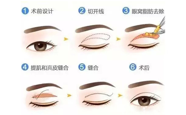 全切雙眼皮跟埋線的區(qū)別是什么？哪個(gè)好？