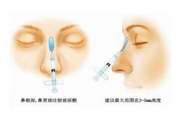 注射隆鼻的優(yōu)點