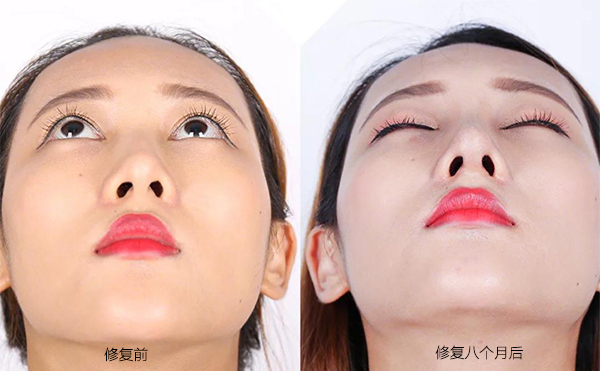 隆鼻手術(shù)失敗怎么辦？修復(fù)費(fèi)用要多少？