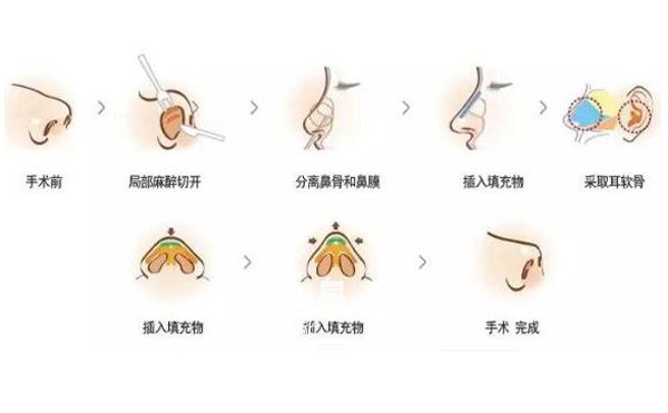 耳軟骨隆鼻效果怎么樣？要多少錢？