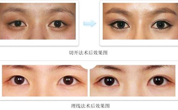 雙眼皮埋線和切開哪個(gè)比較好?疼痛程度有什么不同？