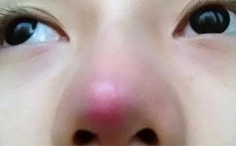 術(shù)后鼻頭發(fā)紅是隆鼻手術(shù)失敗了嗎？該怎么處理？