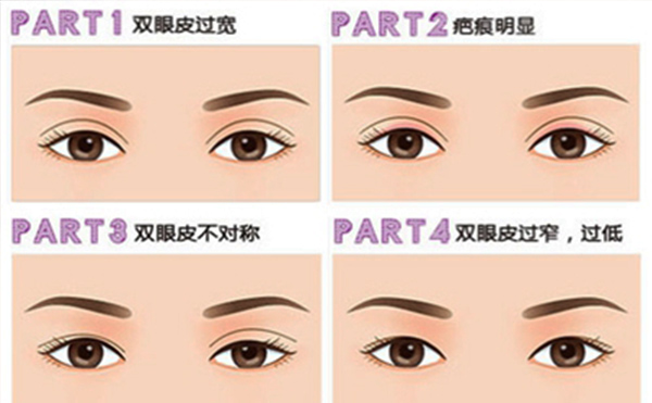 雙眼皮失敗有哪些明顯表現(xiàn)？修復(fù)成功率大嗎？