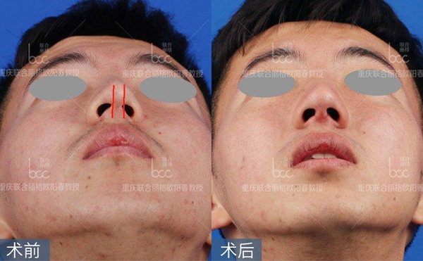 歪鼻修復(fù)術(shù)要多少錢？