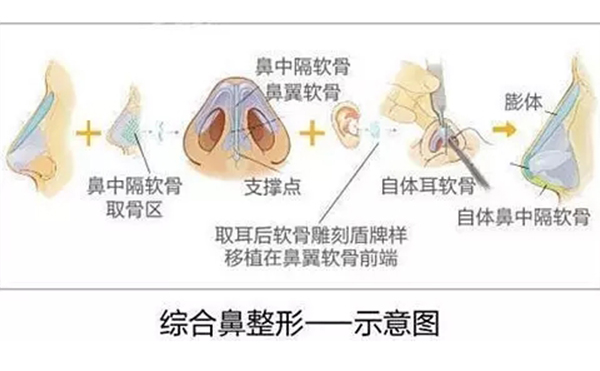 鼻綜合整形的效果怎么樣？鼻綜合手術(shù)安全嗎？