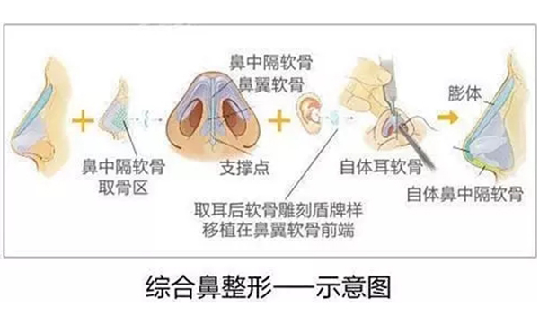 為什么都建議做鼻綜合手術(shù)？