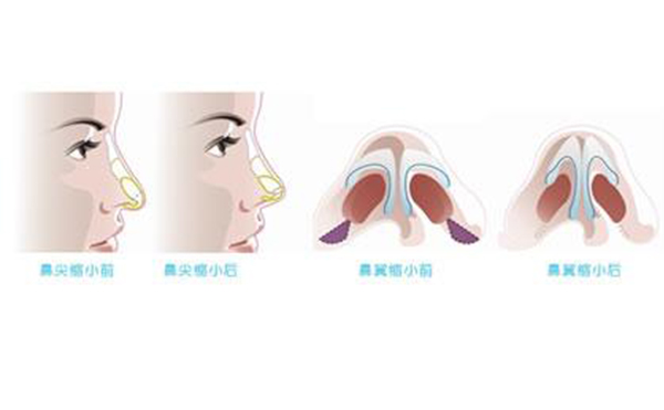鼻翼縮小整形安全嗎？術(shù)后會(huì)不會(huì)影響呼吸