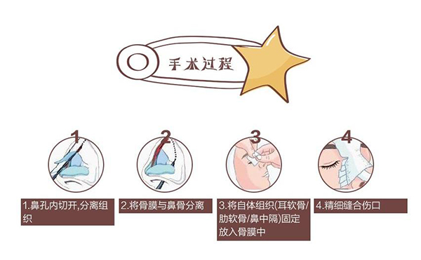 自體軟骨隆鼻為什么這么受歡迎？