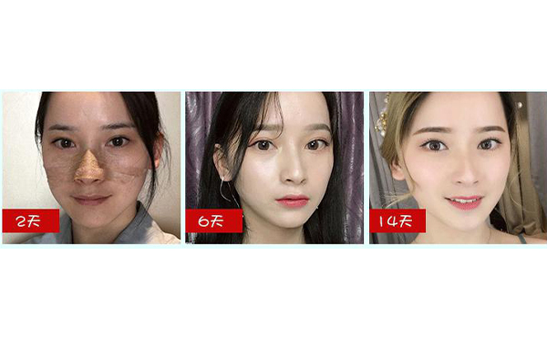 全肋鼻和半肋鼻有什么區(qū)別？做全肋好還是半肋好