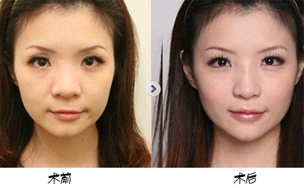 為保證鼻頭肥大矯正手術效果，術前術后應該注意些什么？