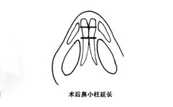 鼻小柱延長(zhǎng)可靠嗎？手術(shù)難度大嗎