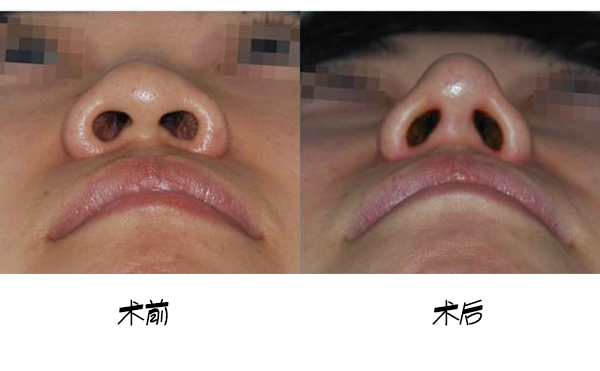 鼻小柱延長手術(shù)的大致流程是什么？手術(shù)成功率高嗎