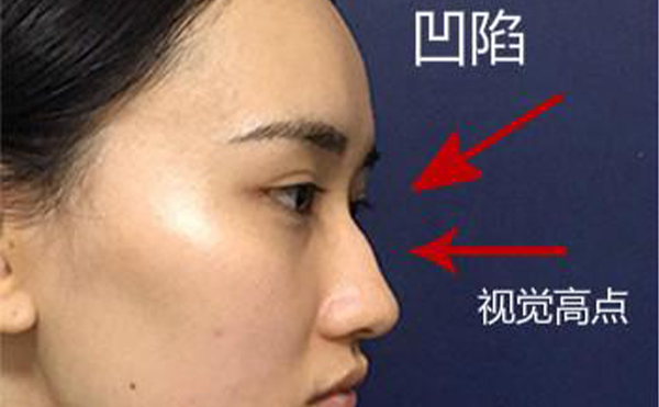 駝峰鼻整形是怎么做的？不同嚴(yán)重程度的駝峰鼻矯正方法一樣嗎？