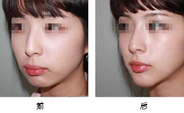 箭鼻是怎么出現(xiàn)的?箭鼻矯正是如何操作的？