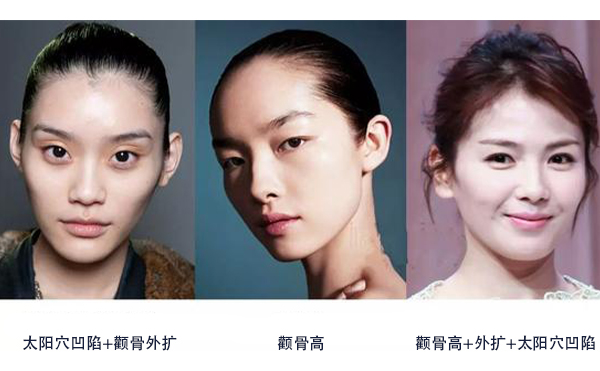 怎么區(qū)分是顴骨高還是太陽(yáng)穴凹陷？