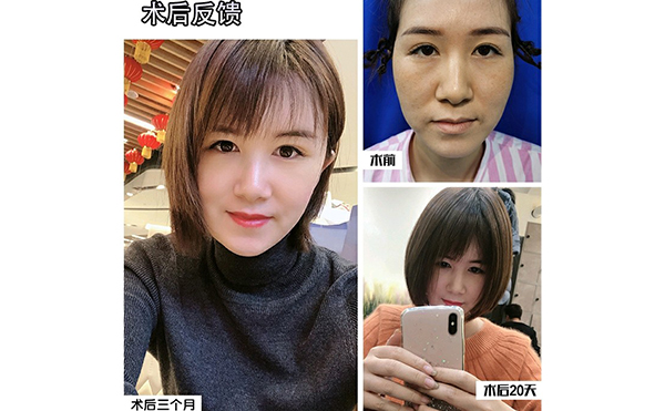 電波拉皮除皺的步驟是什么？
