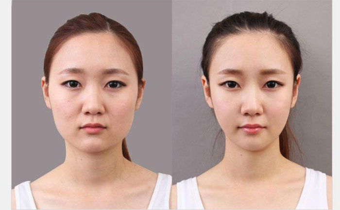 非手術(shù)瘦臉多少錢？非手術(shù)瘦臉方法有哪些？