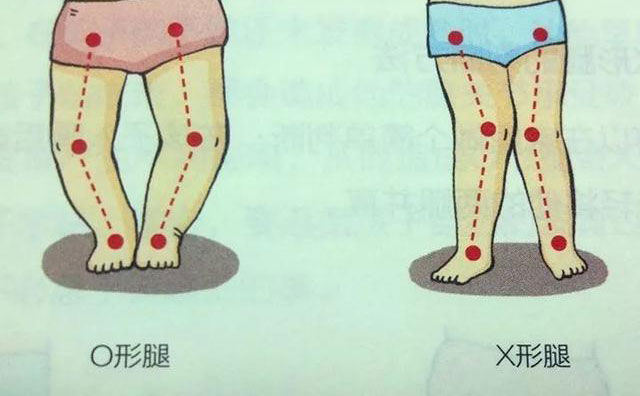 羅圈腿怎樣矯正？羅圈腿手術(shù)矯正多少錢？