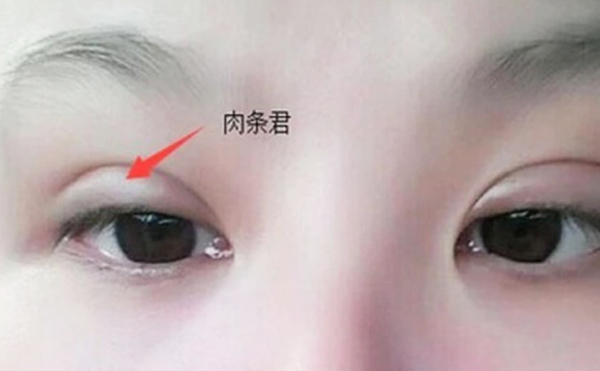 雙眼皮不自然怎么補(bǔ)救？雙眼皮肉條好修復(fù)么？