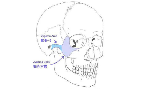 什么樣的臉型需要做顴骨整形？