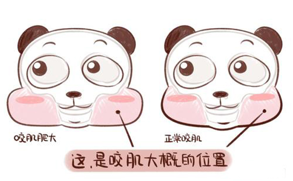 造成咬肌肥大的原因是什么？