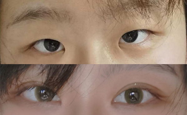 小眼癥矯正的具體方式有哪些?術(shù)后會留疤嗎?