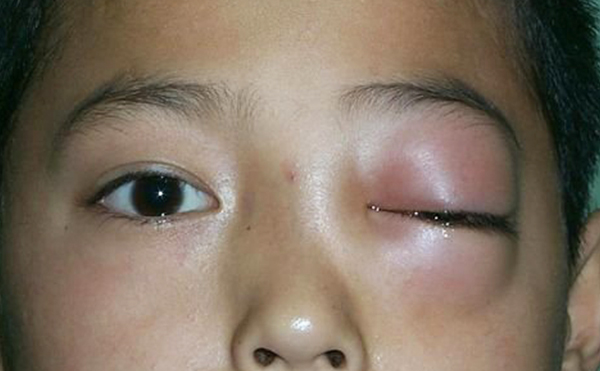 單側(cè)眼球突出什么原因?矯正需要多少錢(qián)?