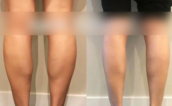 打瘦腿針是怎么操作的？