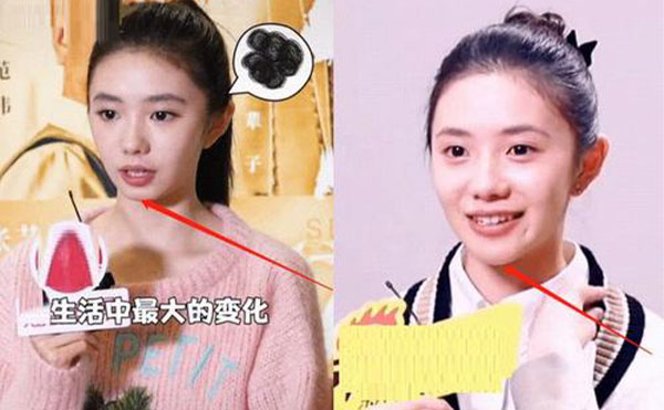 玻尿酸隆下巴整形攻略【優(yōu)勢、適宜人群、注意事項(xiàng)】