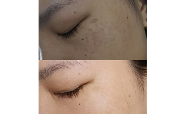 激光美白能維持多久？
