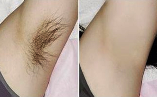 光子脫腋毛有什么優(yōu)勢？