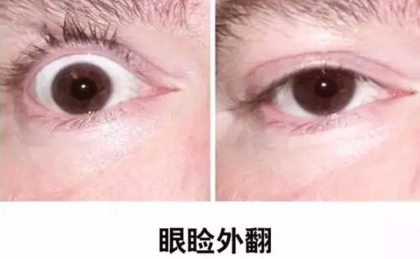 醫(yī)美技術越來越發(fā)達，不少愛美的人本著變美的心情滿懷期待地去做雙眼皮、開眼角等項目，不料整容不成、反倒毀容，后悔也來不及。有些做雙眼皮的姑娘術后出現眼瞼外翻的情況，那眼瞼外翻是什么意思?上眼瞼外翻如何修復?