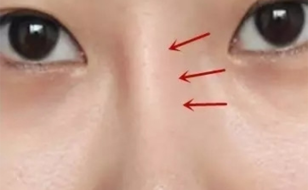 假體隆鼻時間長了出現(xiàn)假體移位等并發(fā)癥后該怎么辦？