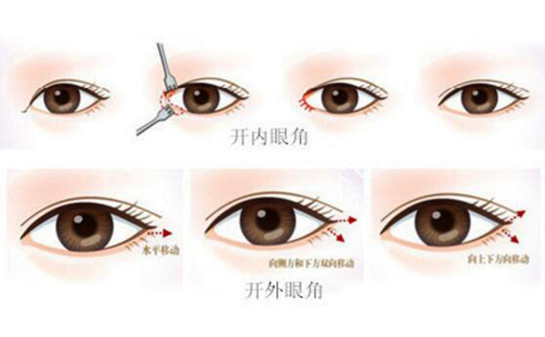 開(kāi)眼角是怎么開(kāi)的?開(kāi)眼角效果大嗎?