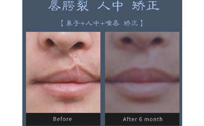 唇裂修復(fù)術(shù)需要多少錢？