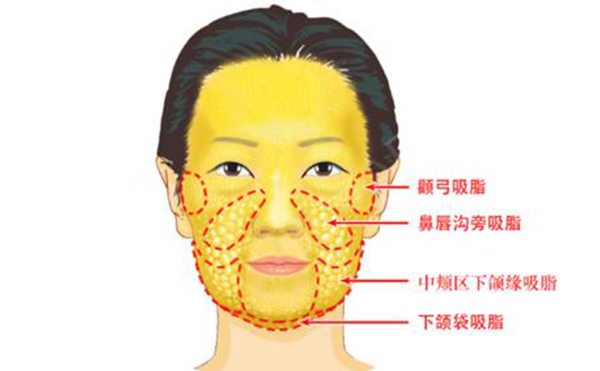 面部吸脂有哪些部位？