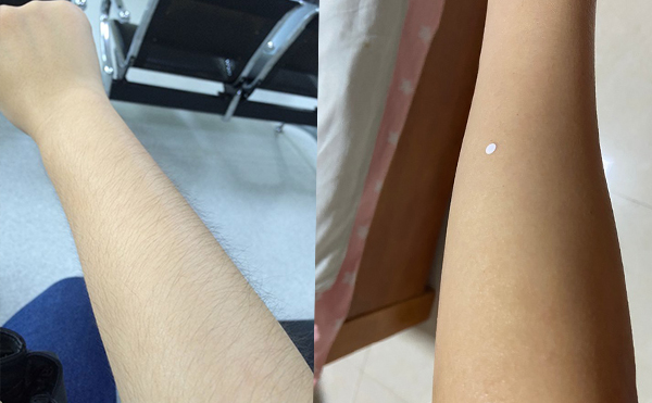 激光手臂脫毛價(jià)格貴不貴？