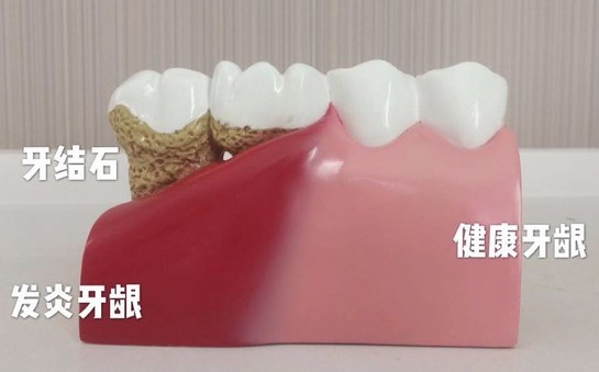 洗完牙后牙齒會變得敏感？