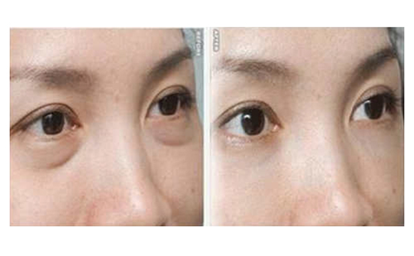 吸脂去眼袋有什么優(yōu)勢(shì)？
